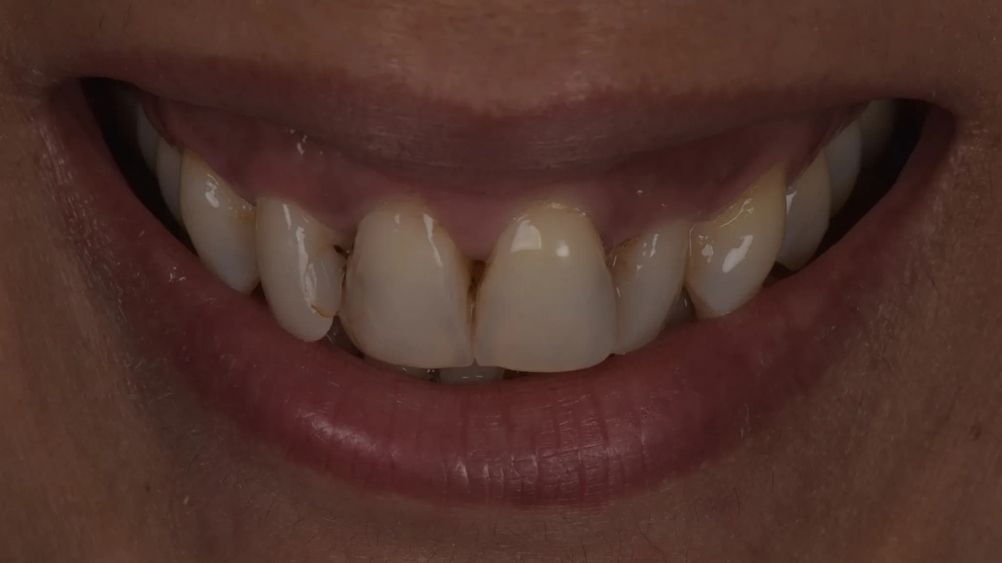 spectrum gallery 02 porcelain veneers earlier