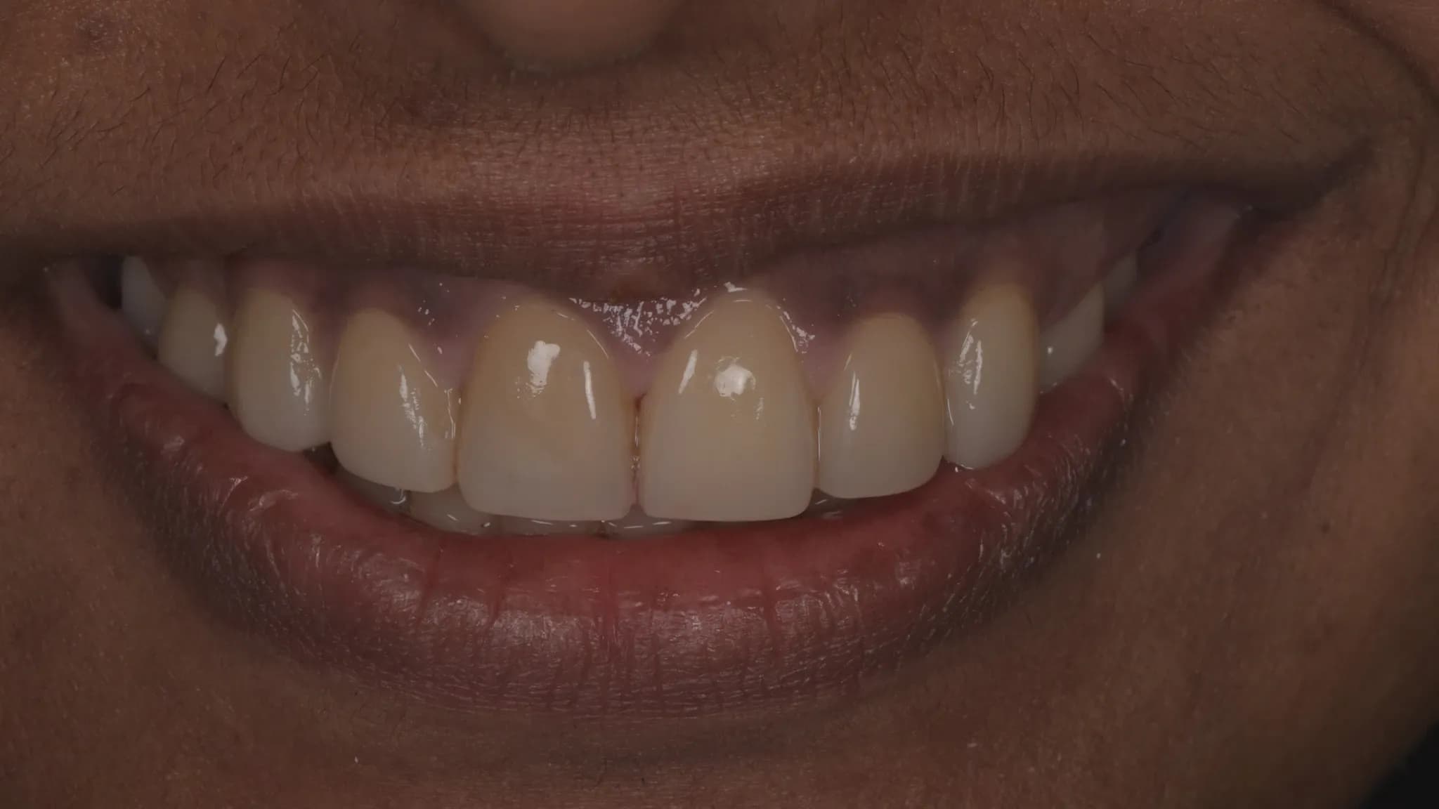 spectrum gallery 03 orthodontics and veneers later