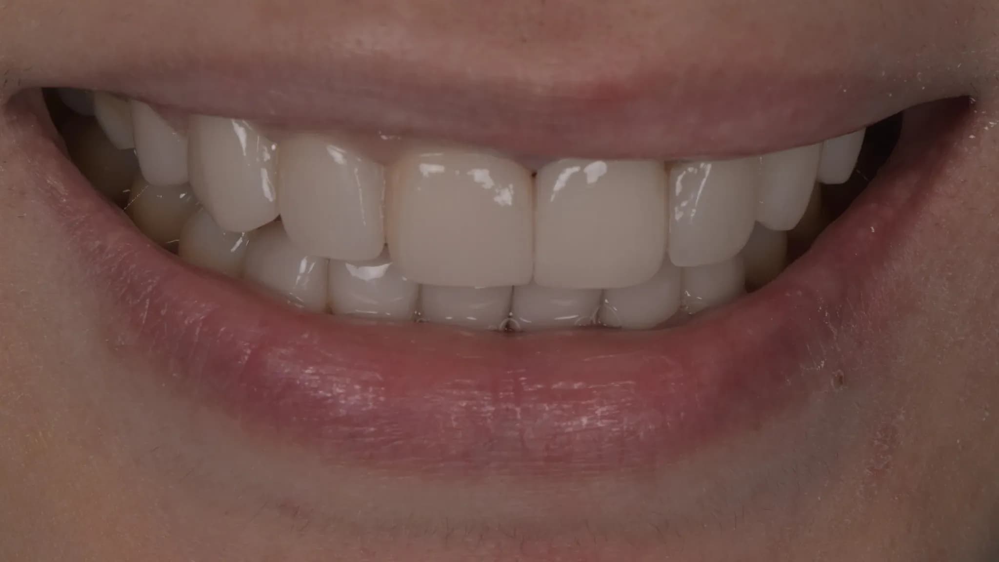 spectrum gallery 05 ultrathin veneers later