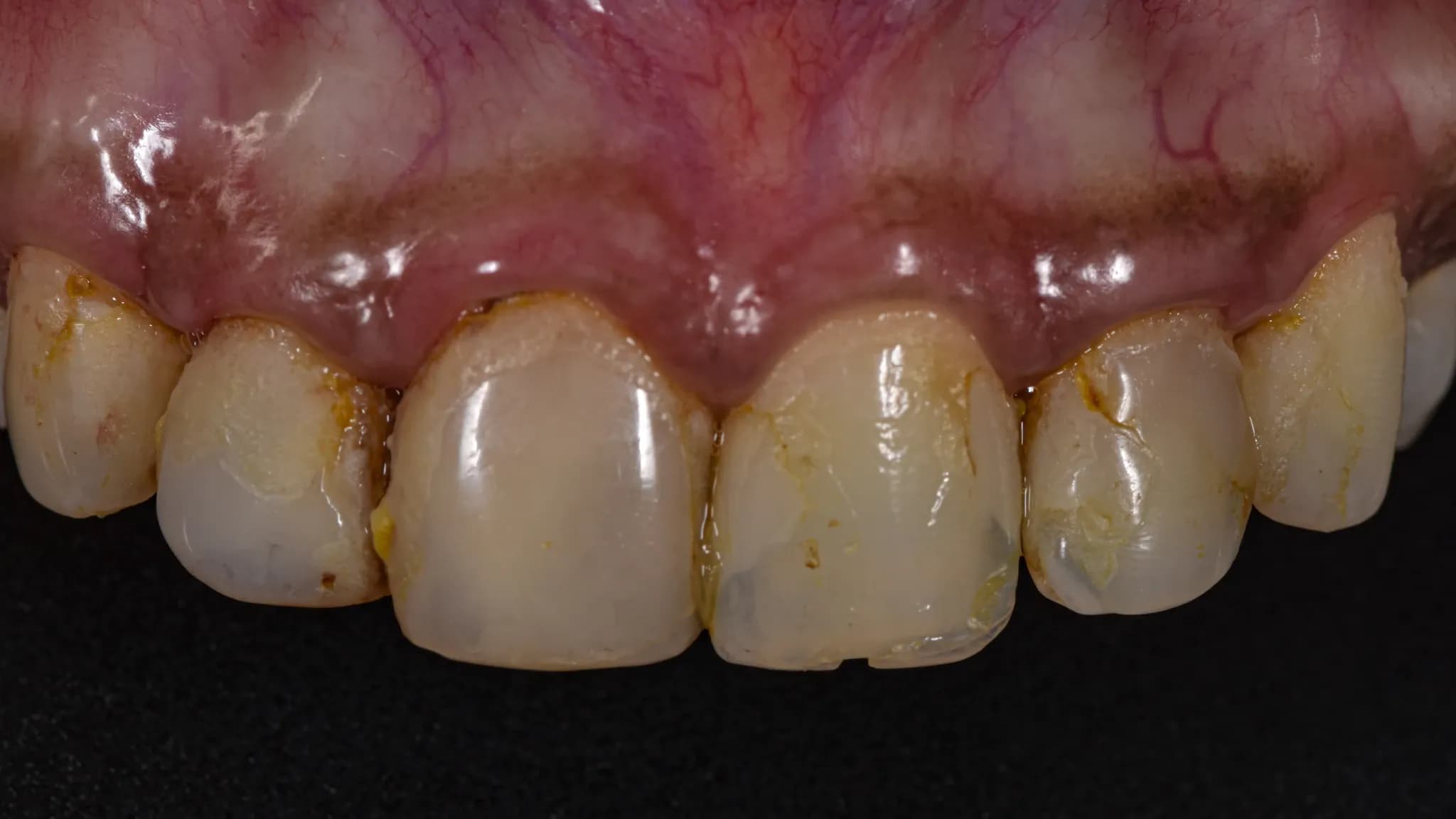 spectrum gallery 06 anterior crowns earlier
