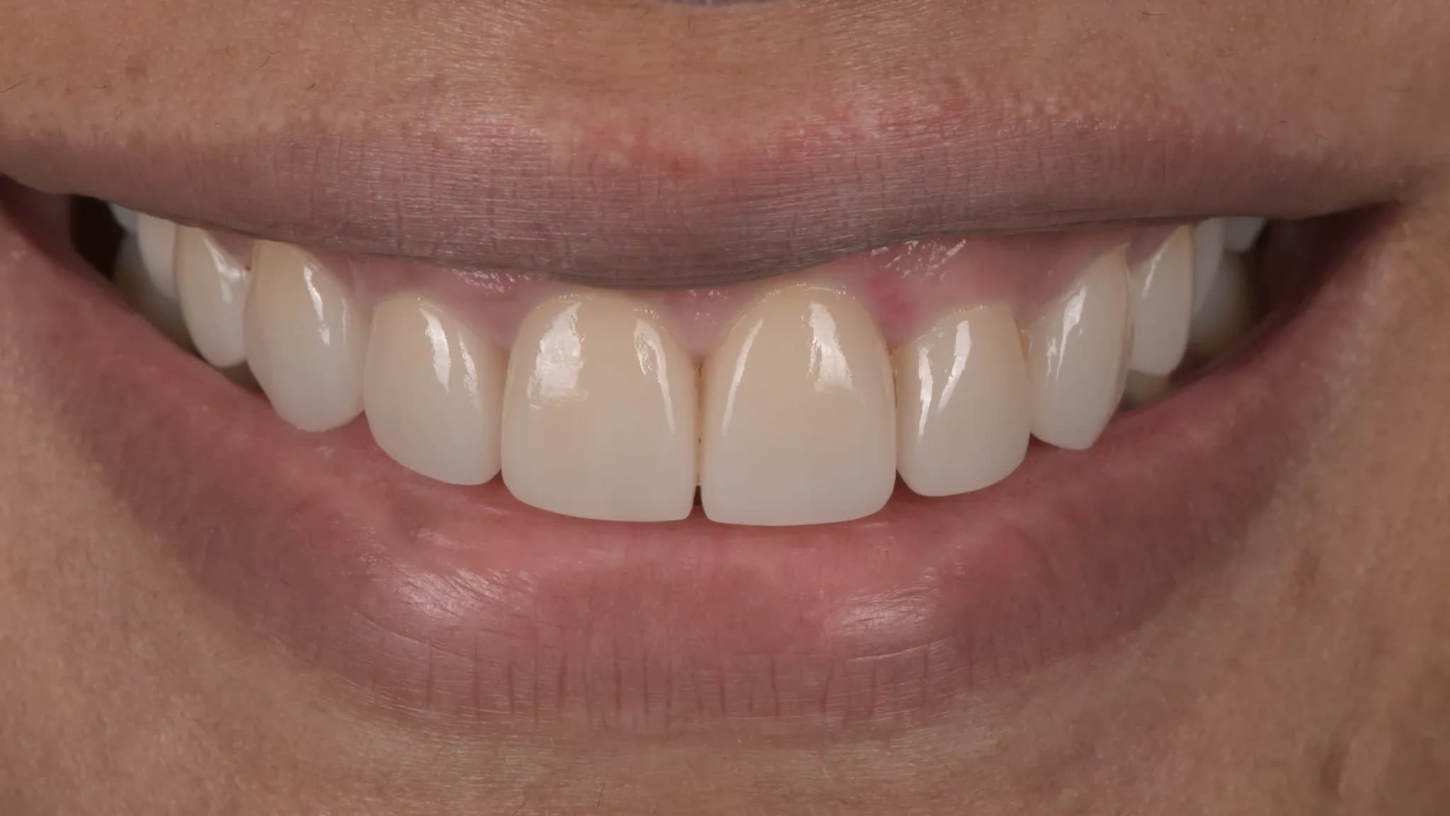 spectrum gallery 08 replacement of discoloured fillings later