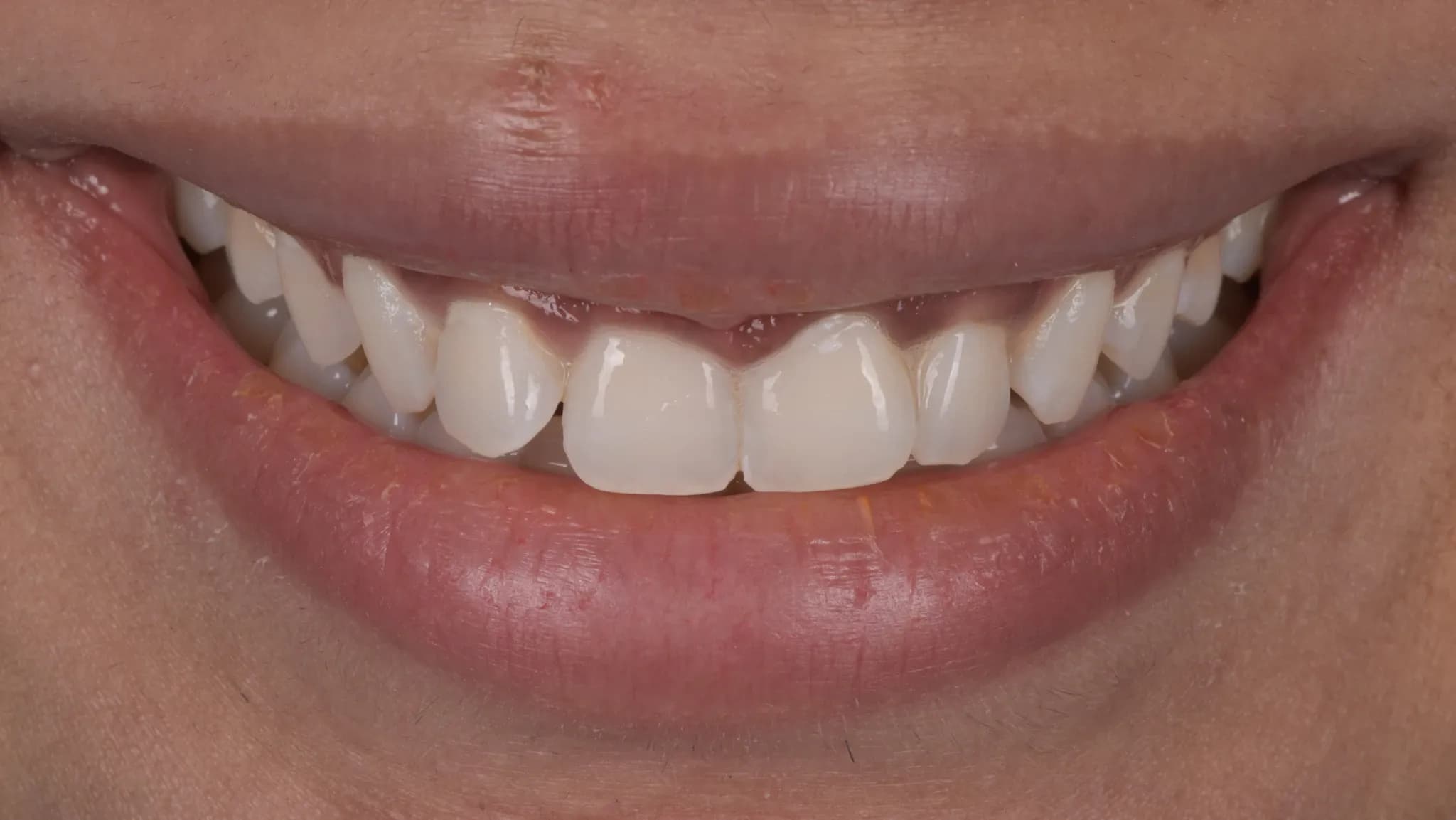 spectrum gallery 10 teeth whitening later