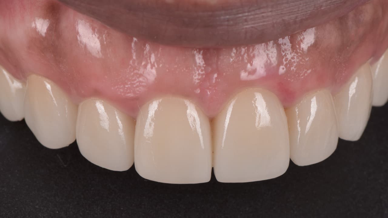 Smile Makeover Old Fillings to New after image