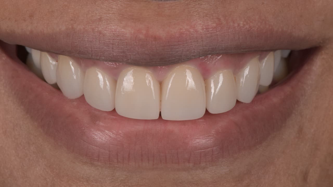 Smile Makeover Old Fillings to New after image