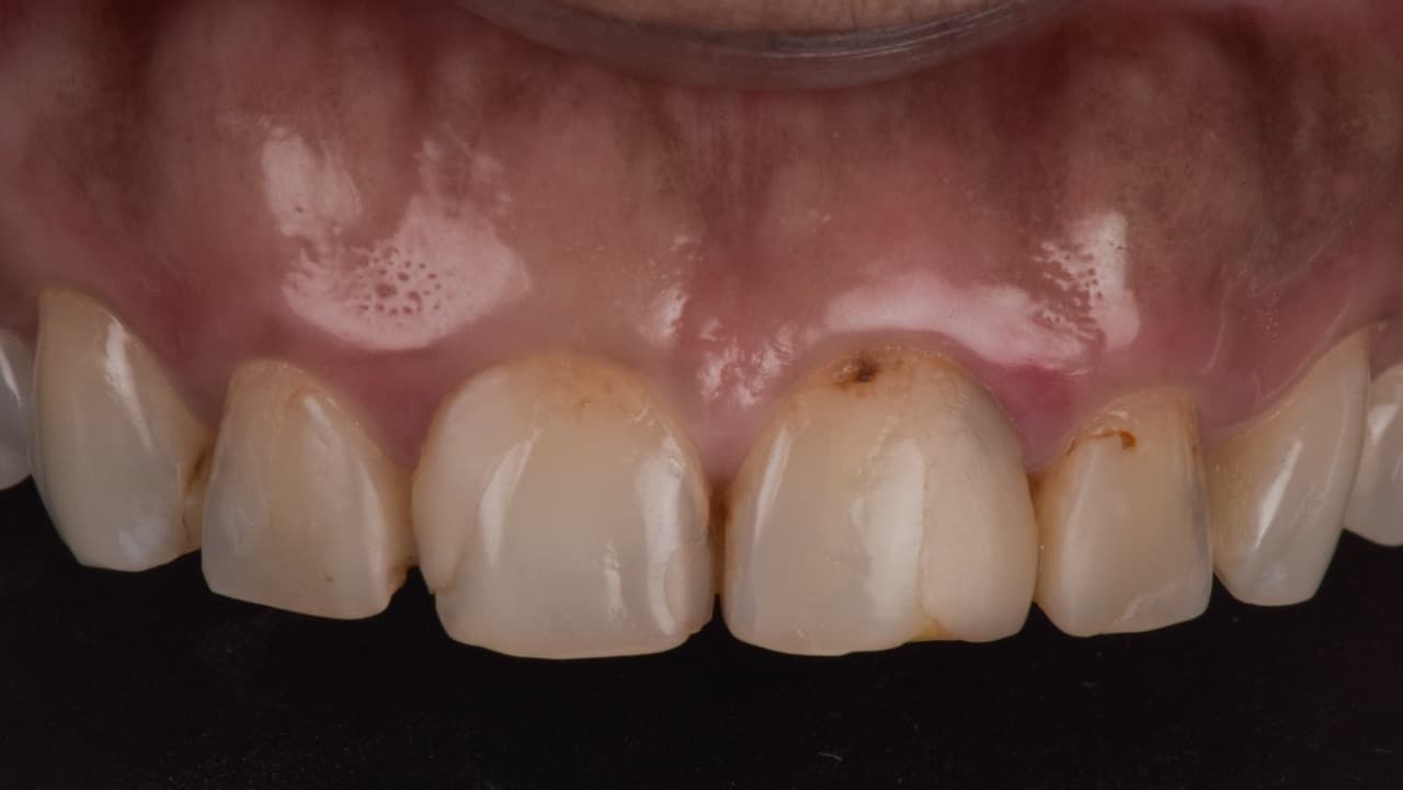 Smile Makeover Old Fillings to New before image 2