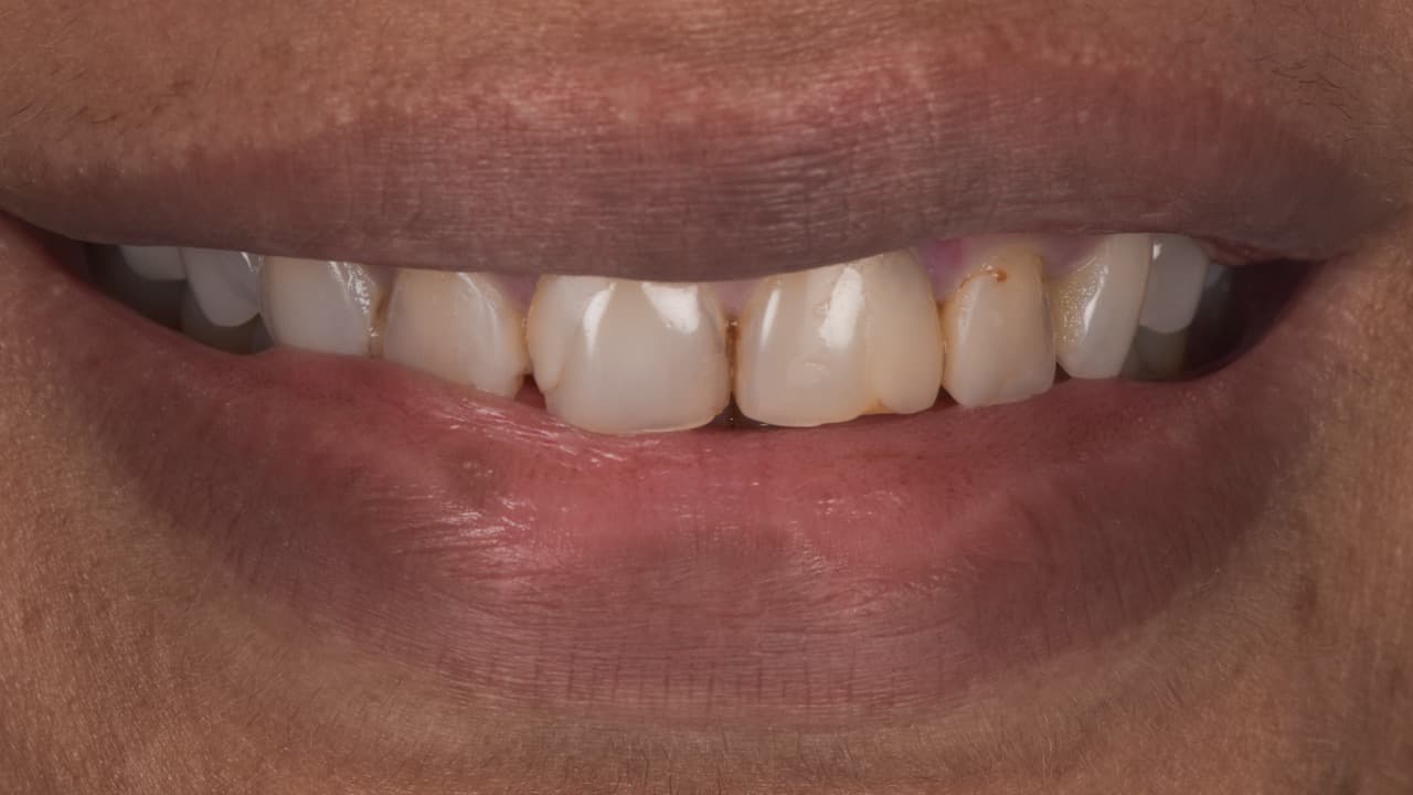 Smile Makeover Old Fillings to New before image