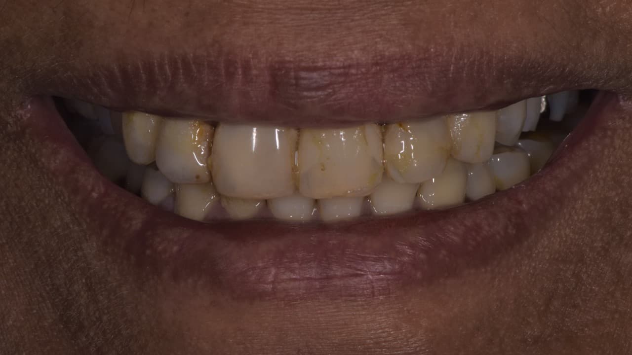 Before image of anterior crowns procedure  spectrum advanced dental care in mumbai