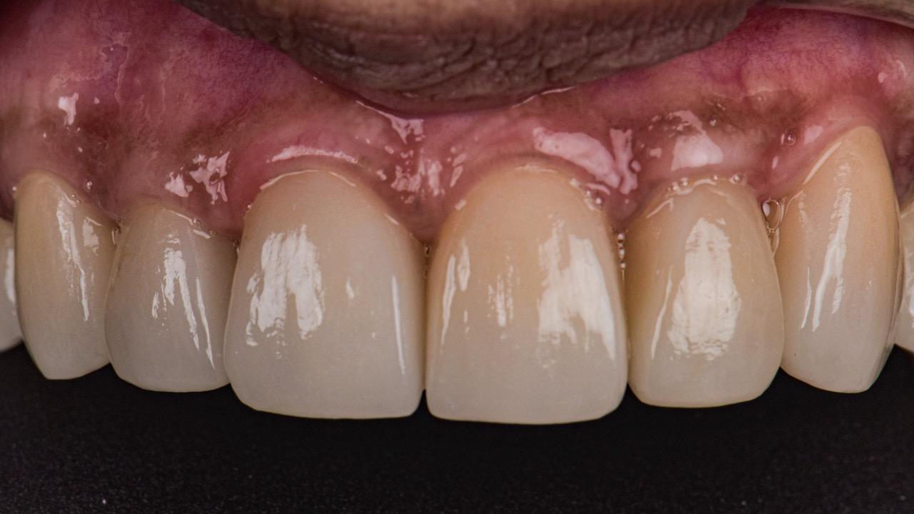 After image of anterior crowns procedure  spectrum advanced dental care in mumbai