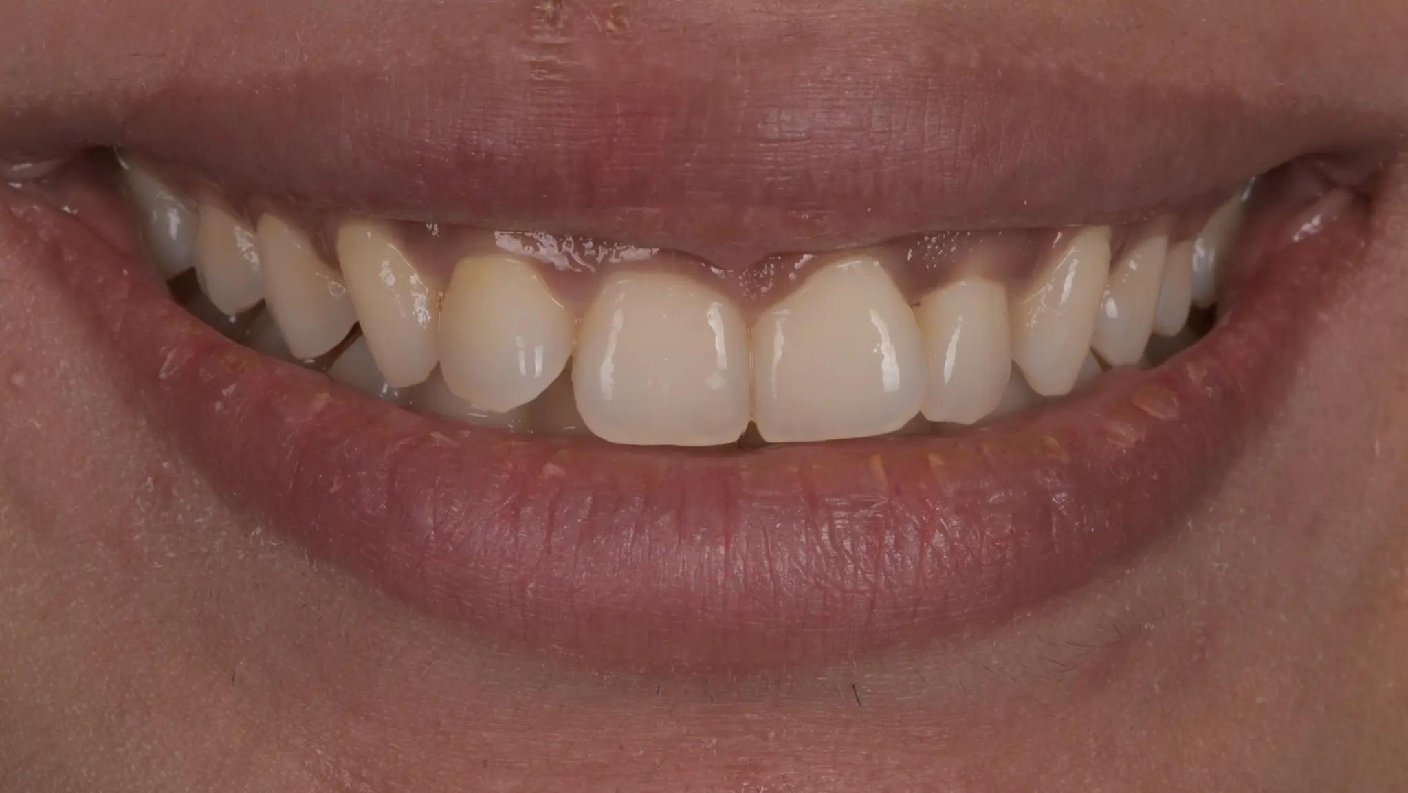 Pictore of teeth before cleaning at Spectrum Advanced Dental Care