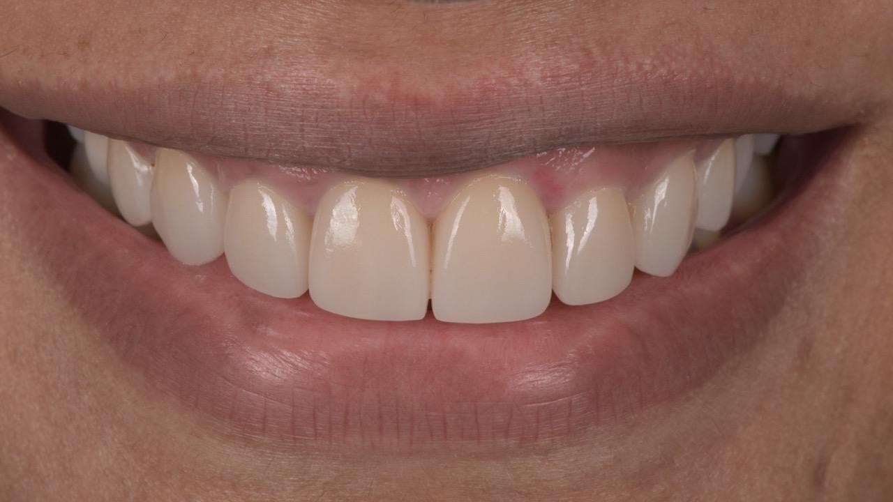 Smile Makeover Old Fillings to New after image