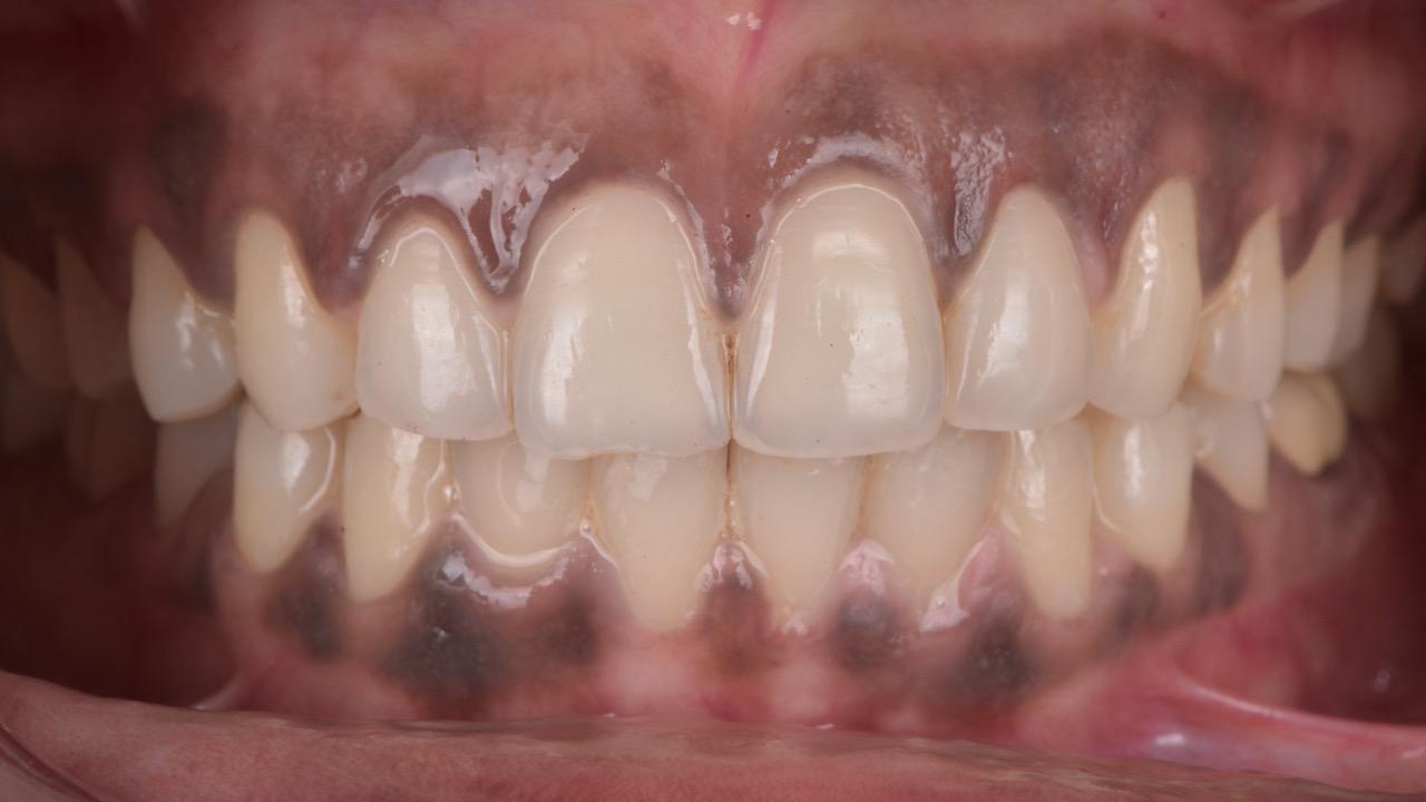 Spectrum Advanced Dental Care Mumbai Space Closure Orthodontics After Image 2