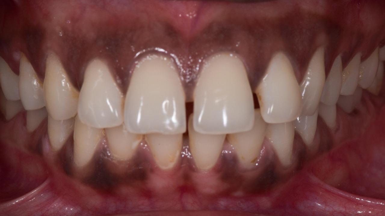 Spectrum Advanced Dental Care Mumbai Space Closure Orthodontics Before Image 2