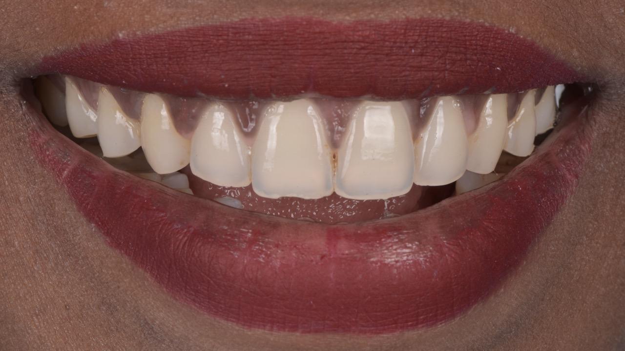Spectrum Advanced Dental Care Mumbai Space Closure Orthodontics after Image 
