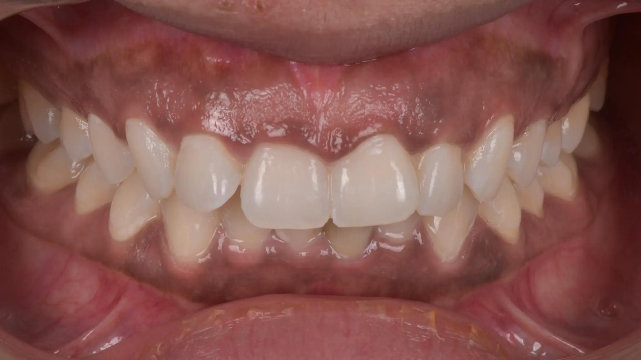 cleaner teeth after cleaning and bleaching at Spectrum-Advanced-Dental-Care