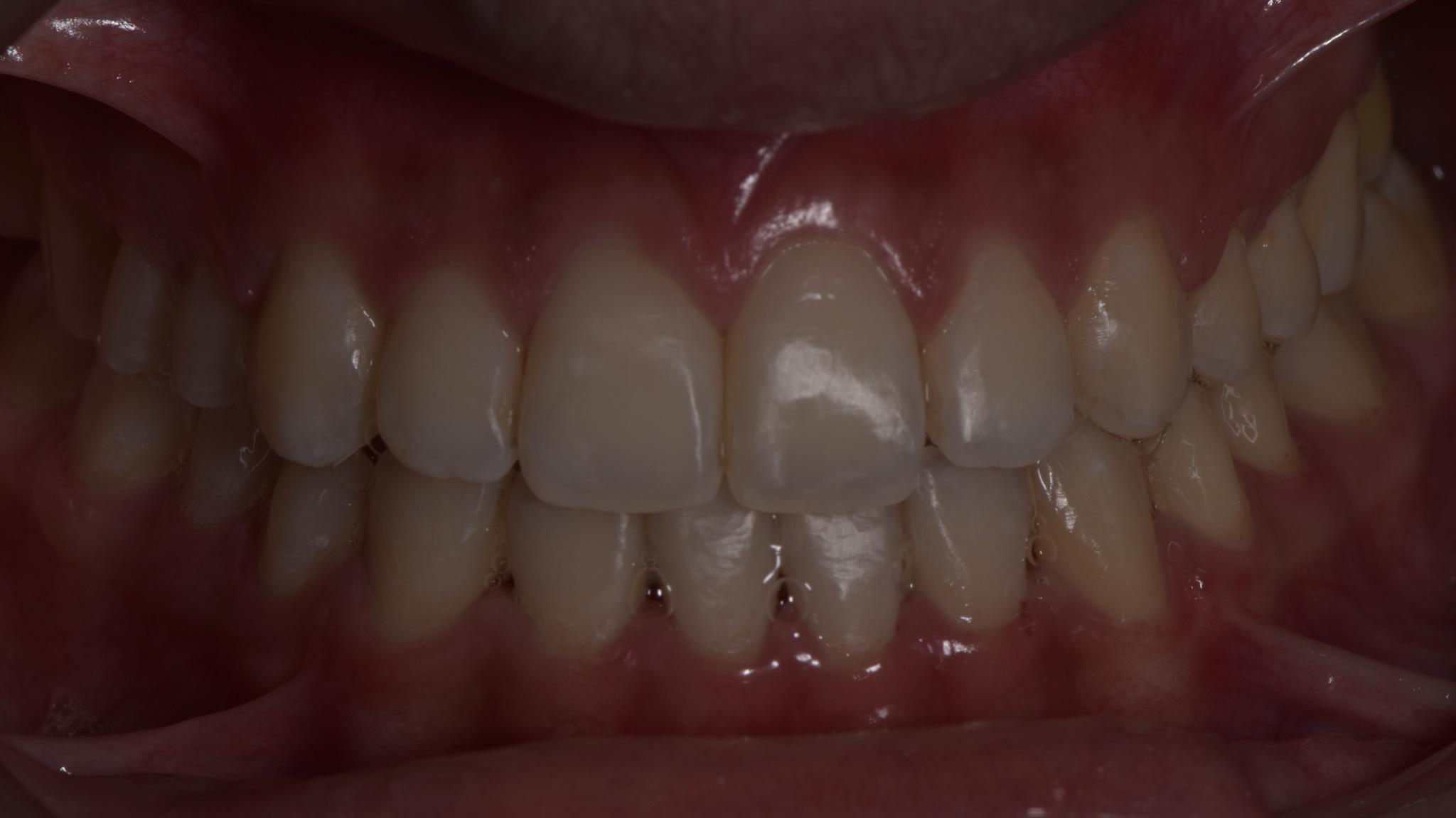 After image of teeth orthodontics procedure  spectrum advanced dental care in mumbai