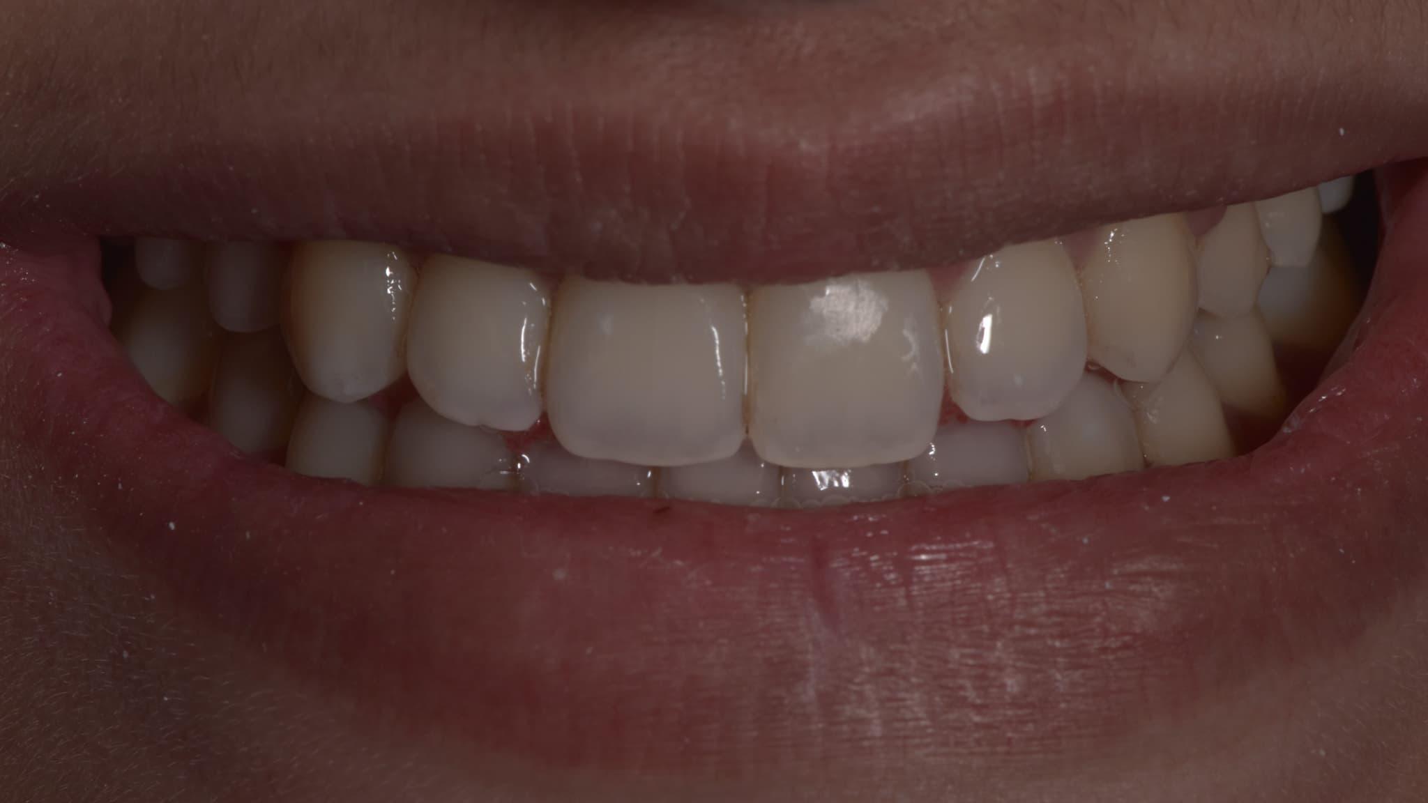 Teeth orthodontics Image After at spectrum advanced dental care mumbai