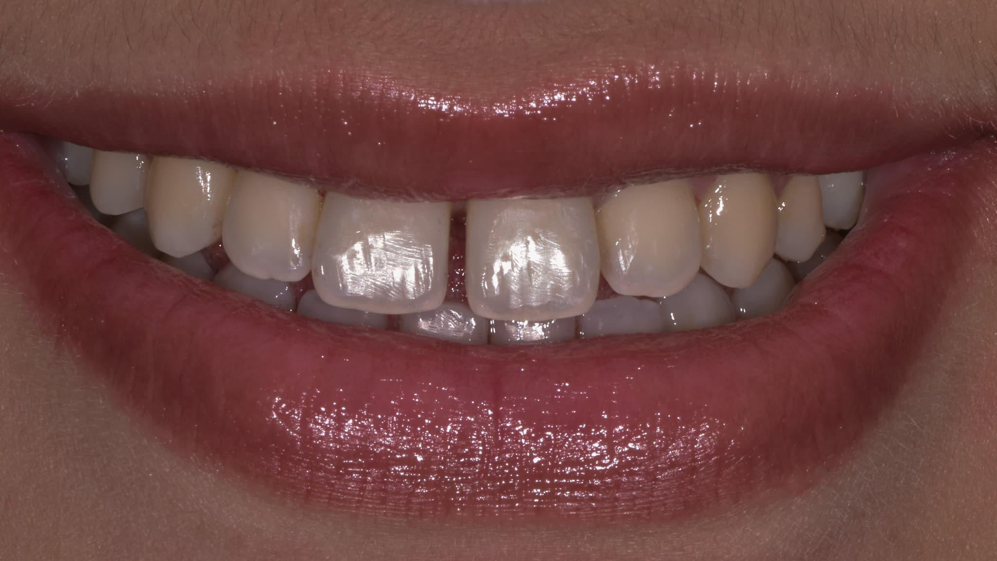 Teeth Orthodontics before Image at spectrum advanced dental care Mumbai