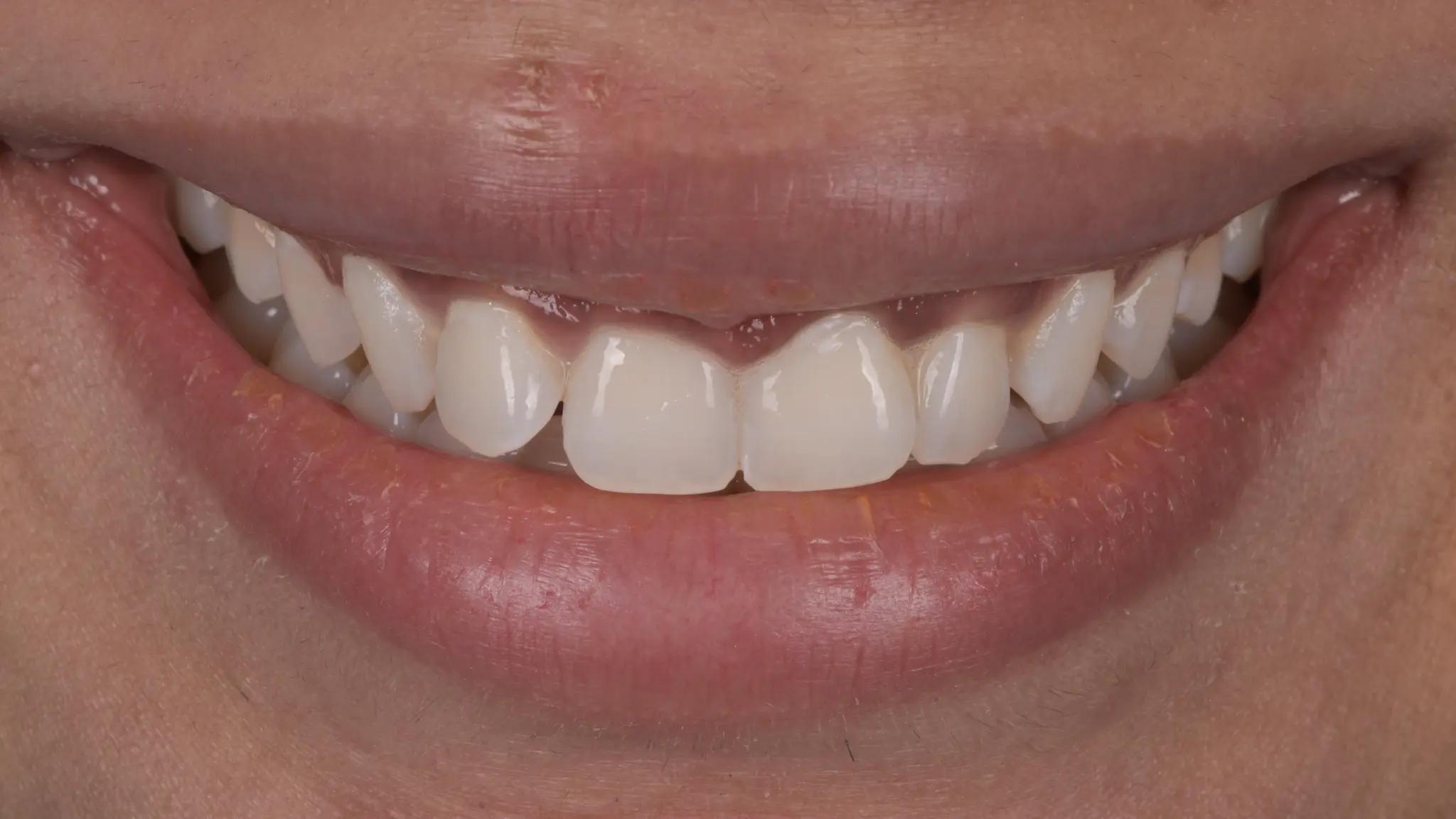 Sparkling teeth after bleaching at Spectrum Advance Dental Cate