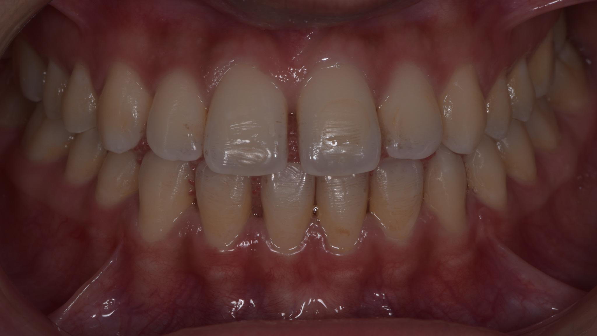 Before image of teeth orthodontics procedure  spectrum advanced dental care in mumbai