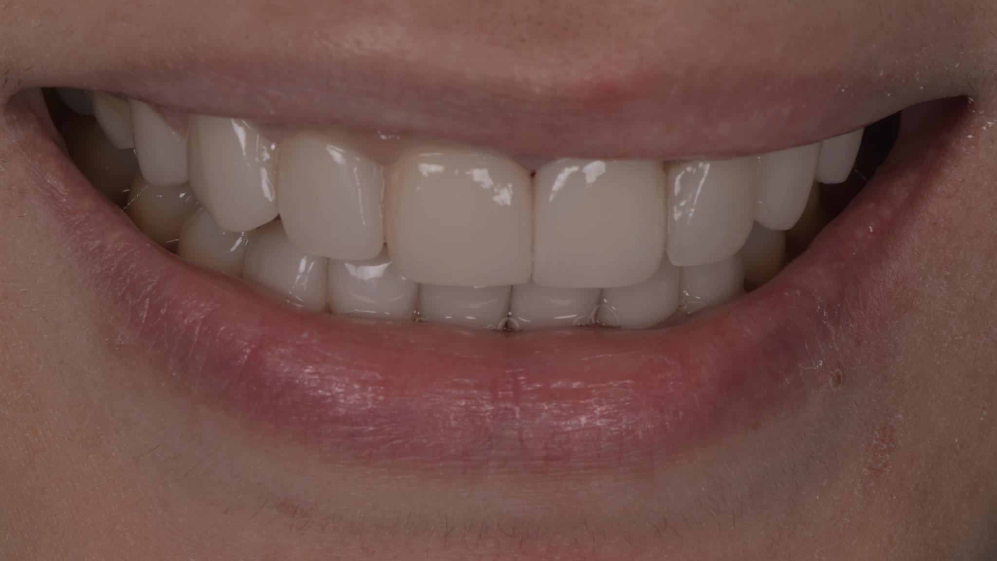 After image of ultra-thin veneers procedure spectrum advanced dental care in mumbai