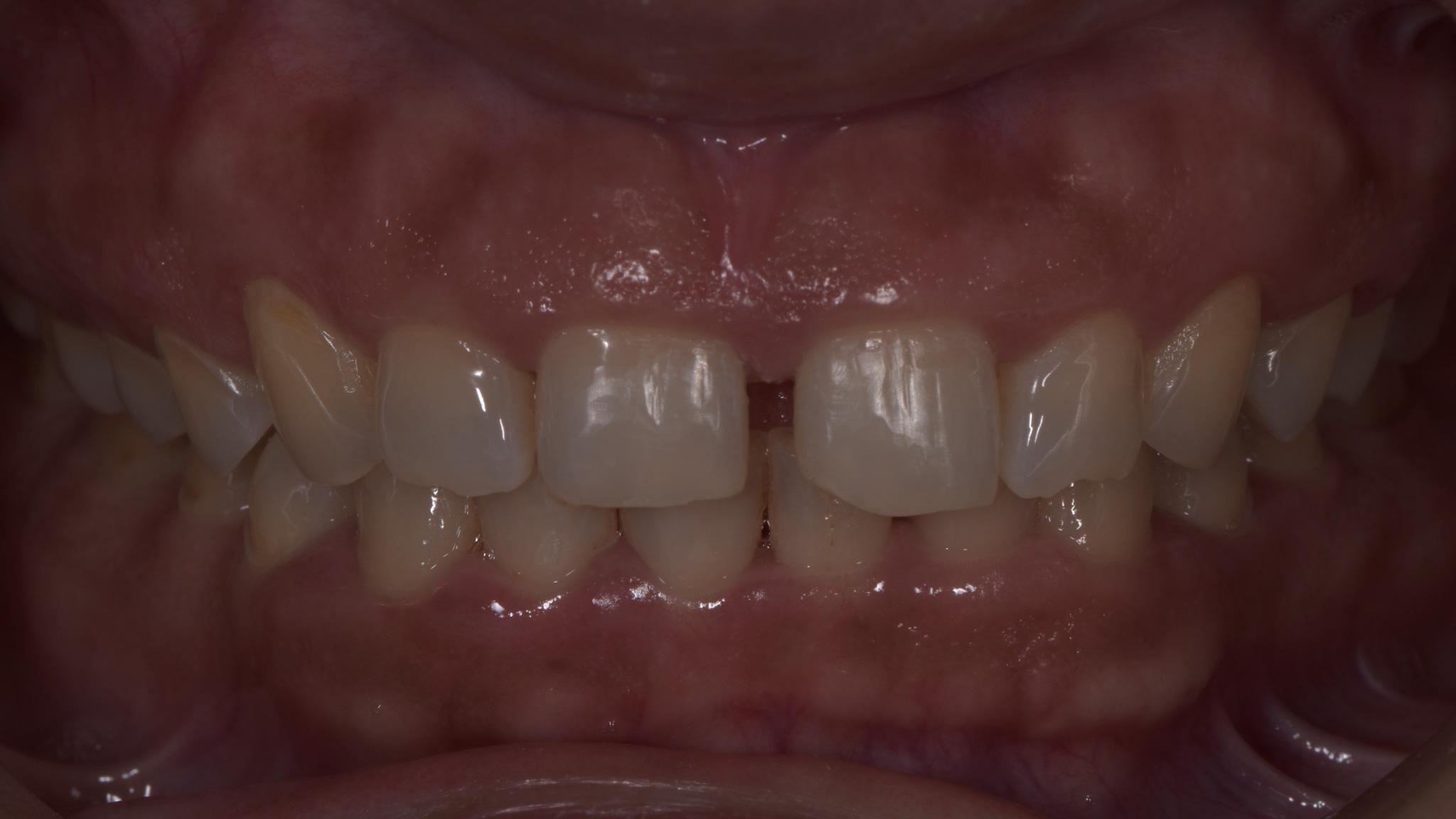 Before image of ultra-thin veneers procedure spectrum advanced dental care in mumbai