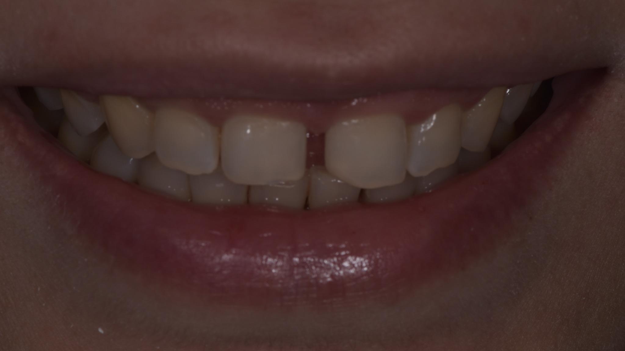 Before image of ultra-thin veneers procedure spectrum advanced dental care in mumbai