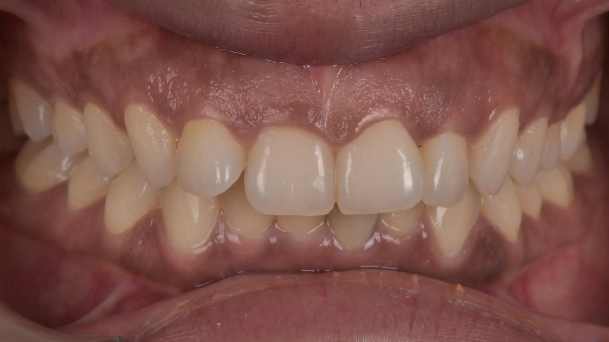 Yellow teeth before cleaning at Spectrum Advanced Dental Care